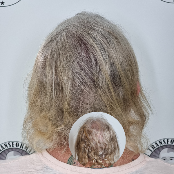 My Transformation,, Women's Hair Tattoo Perth, SMP Perth, SMP WA, Sclp Micropigmentation For Women