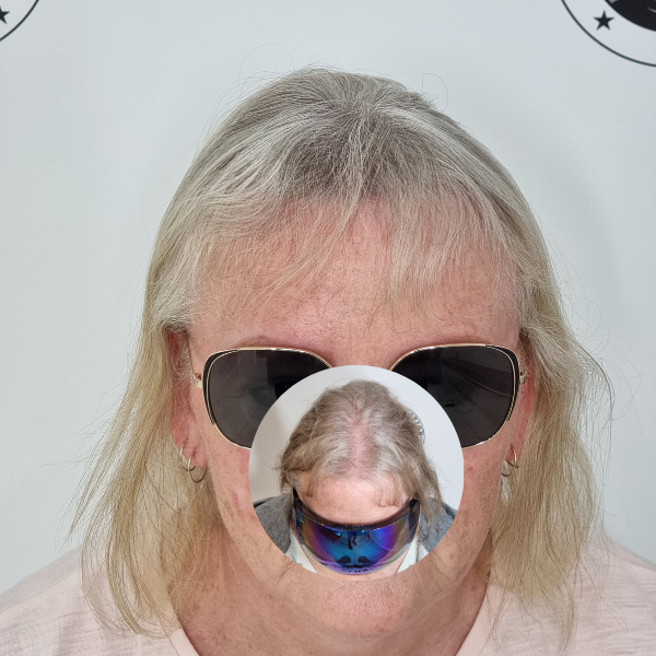 My Transformation,, Women's Hair Tattoo Perth, SMP Perth, SMP WA, Sclp Micropigmentation For Women