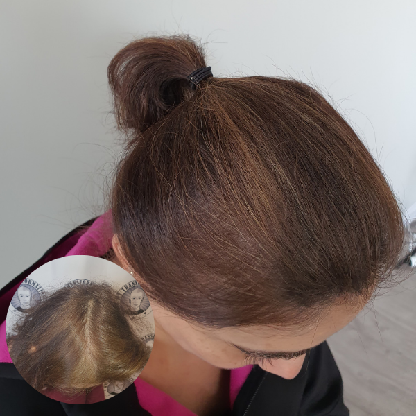 My Transformation,, Women's Hair Tattoo Perth, SMP Perth, SMP WA, Sclp Micropigmentation For Women , Hair Density For Women