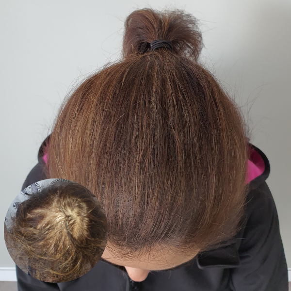 My Transformation,, Women's Hair Tattoo Perth, SMP Perth, SMP WA, Sclp Micropigmentation For Women , Hair Density For Women