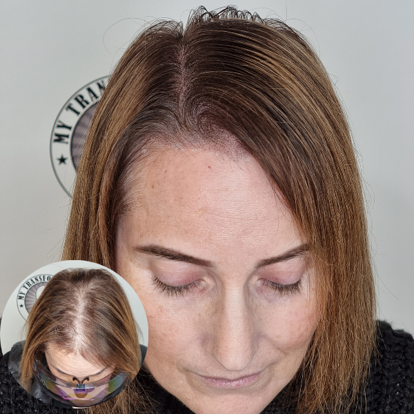 My Transformation,, Women's Hair Tattoo Perth, SMP Perth, SMP WA, Sclp Micropigmentation For Women , Hair Density For Women