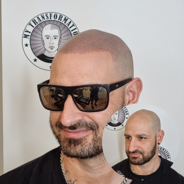 My Transformation, Scalp Micropigmentation Perth, Hair Tattoo Perth, MP Perth, SMP WA, Perth Australia