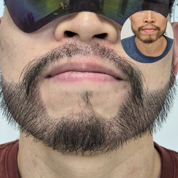 My Transformation, Beard Micropigmentation Perth, Hair Tattoo Perth, SMP Perth, SMP WA, Beard Tattoo