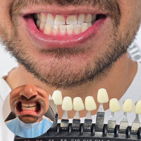 My Transformation, Teeth Witening Perth, Cosmetic Whitening, Instantley A Whiter Smile, Affordable Cosmetic Teeth Whitening,