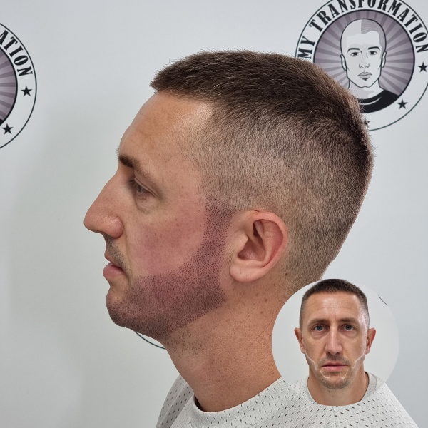 My Transformation, Beard Micropigmentation Perth, Hair Tattoo Perth, SMP Perth, SMP WA, Beard Tattoo