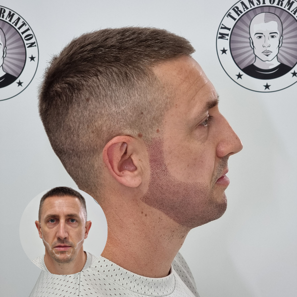 My Transformation, Beard Micropigmentation Perth, Hair Tattoo Perth, SMP Perth, SMP WA, Beard Tattoo