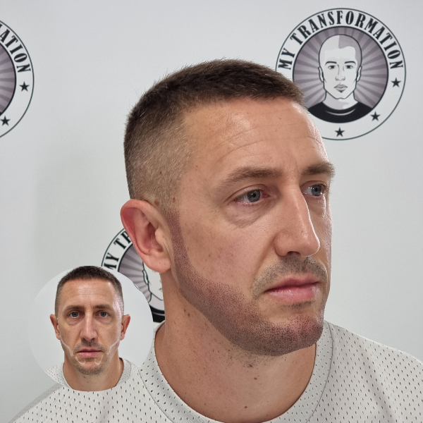 My Transformation, Beard Micropigmentation Perth, Hair Tattoo Perth, SMP Perth, SMP WA, Beard Tattoo