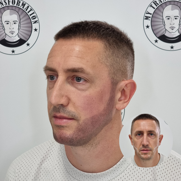 My Transformation, Beard Micropigmentation Perth, Hair Tattoo Perth, SMP Perth, SMP WA, Beard Tattoo