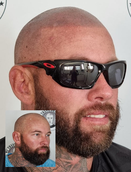 My Transformation, Scalp Micropigmentation Perth, Hair Tattoo Perth, MP Perth, SMP WA, Perth Australia