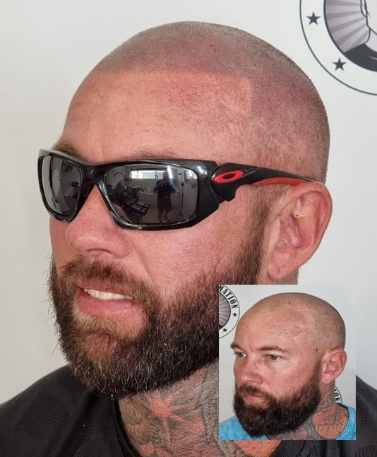 My Transformation, Scalp Micropigmentation Perth, Hair Tattoo Perth, MP Perth, SMP WA, Perth Australia