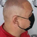 My Transformation, Scalp Micropigmentation Perth, Hair Tattoo Perth, SMP Perth, SMP WA, Perth Australia