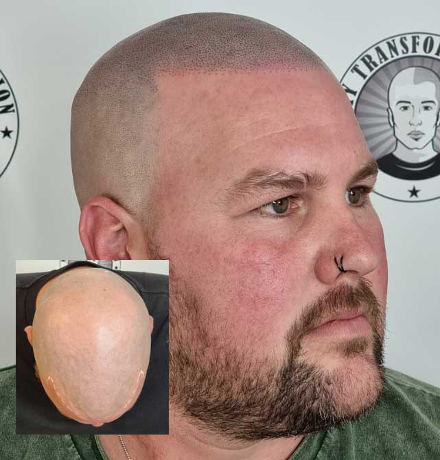 My Transformation, Scalp Micropigmentation Perth, Hair Tattoo Perth, MP Perth, SMP WA, Perth Australia
