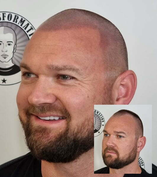 My Transformation, Scalp Micropigmentation Perth, Hair Tattoo Perth, MP Perth, SMP WA, Perth Australia