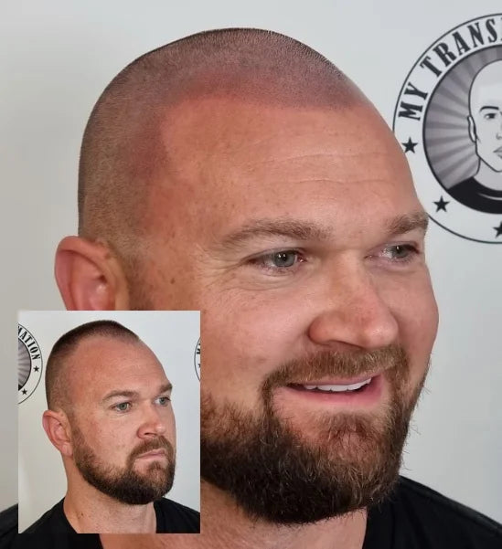 My Transformation, Scalp Micropigmentation Perth, Hair Tattoo Perth, MP Perth, SMP WA, Perth Australia