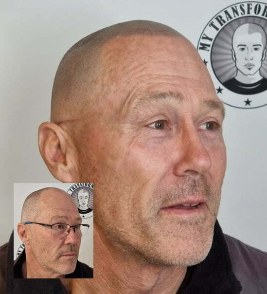 My Transformation, Scalp Micropigmentation Perth, Hair Tattoo Perth, MP Perth, SMP WA, Perth Australia
