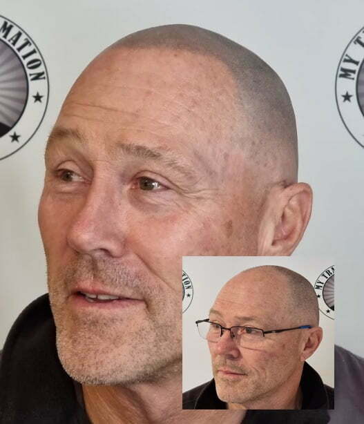 My Transformation, Scalp Micropigmentation Perth, Hair Tattoo Perth, MP Perth, SMP WA, Perth Australia
