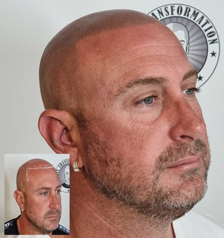 My Transformation, Scalp Micropigmentation Perth, Hair Tattoo Perth, MP Perth, SMP WA, Perth Australia