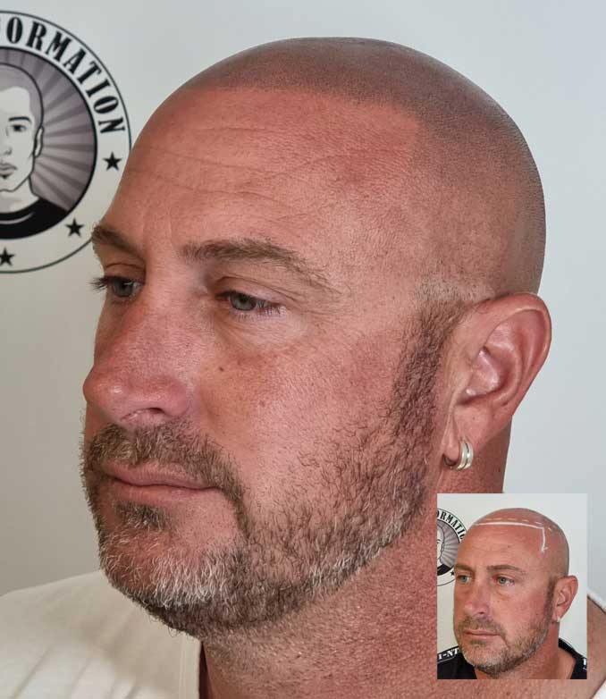 My Transformation, Scalp Micropigmentation Perth, Hair Tattoo Perth, MP Perth, SMP WA, Perth Australia
