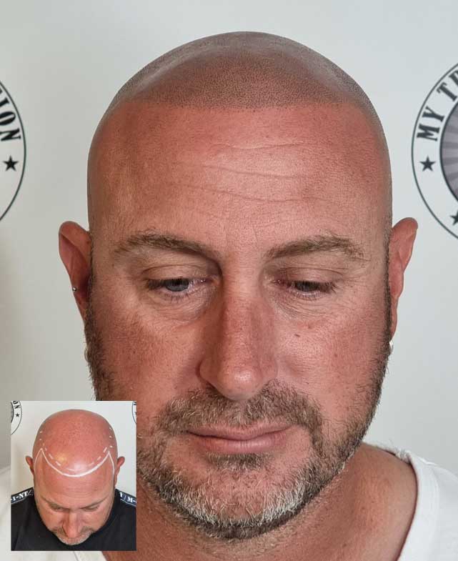 My Transformation, Scalp Micropigmentation Perth, Hair Tattoo Perth, MP Perth, SMP WA, Perth Australia
