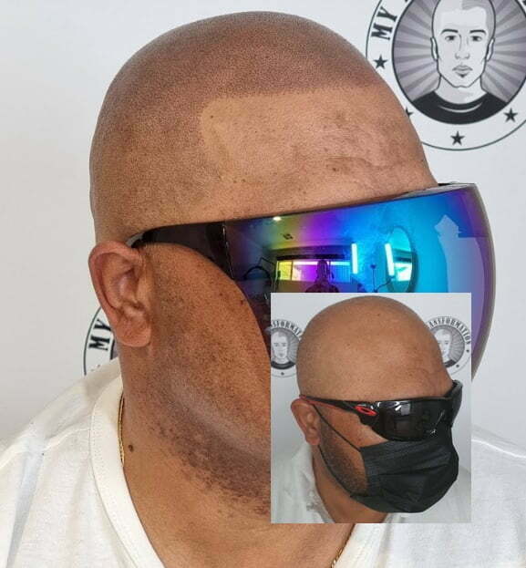 My Transformation, Scalp Micropigmentation Perth, Hair Tattoo Perth, MP Perth, SMP WA, Perth Australia