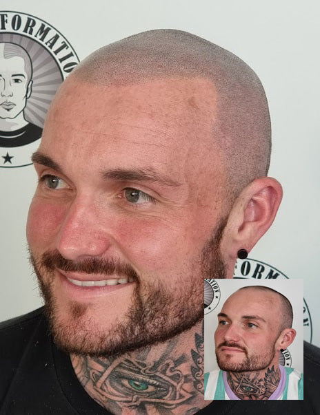 My Transformation, Scalp Micropigmentation Perth, Hair Tattoo Perth, SMP Perth, SMP WA, Perth Australia