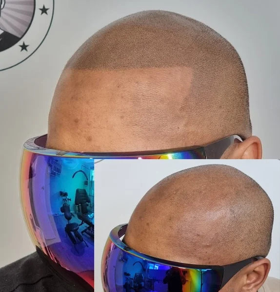 My Transformation, Scalp Micropigmentation Perth, Hair Tattoo Perth, MP Perth, SMP WA, Perth Australia