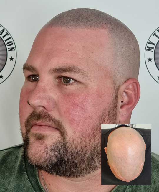 My Transformation, Scalp Micropigmentation Perth, Hair Tattoo Perth, MP Perth, SMP WA, Perth Australia