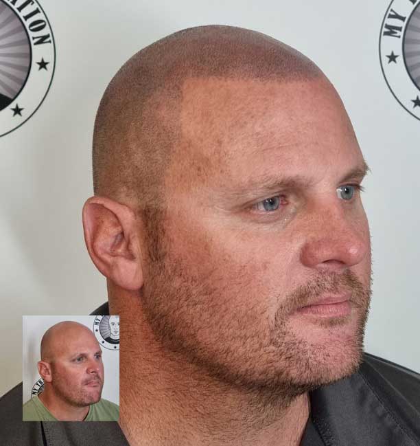 My Transformation, Scalp Micropigmentation Perth, Hair Tattoo Perth, MP Perth, SMP WA, Perth Australia