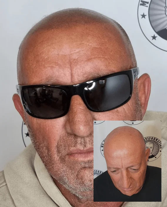 My Transformation, Scalp Micropigmentation Perth, Hair Tattoo Perth, MP Perth, SMP WA, Perth Australia
