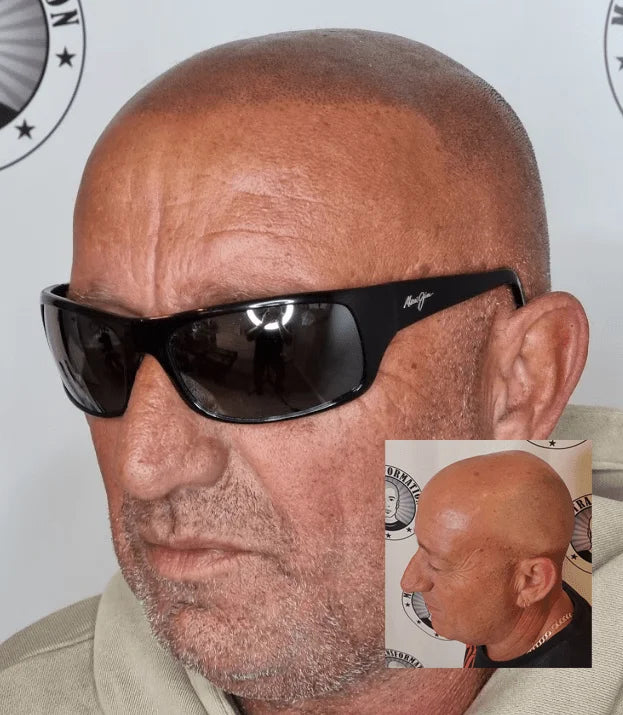 My Transformation, Scalp Micropigmentation Perth, Hair Tattoo Perth, MP Perth, SMP WA, Perth Australia