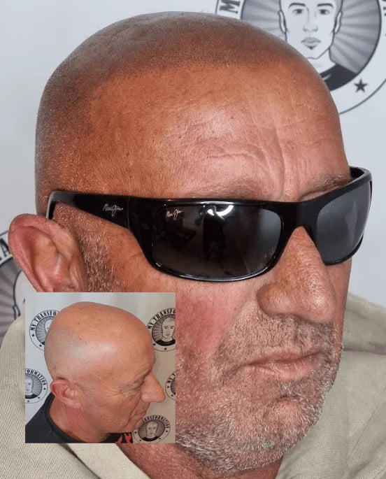 My Transformation, Scalp Micropigmentation Perth, Hair Tattoo Perth, MP Perth, SMP WA, Perth Australia