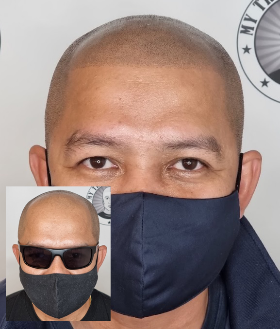 My Transformation, Scalp Micropigmentation Perth, Hair Tattoo Perth, MP Perth, SMP WA, Perth Australia