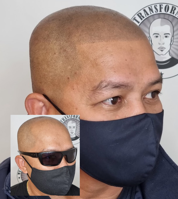 My Transformation, Scalp Micropigmentation Perth, Hair Tattoo Perth, MP Perth, SMP WA, Perth Australia
