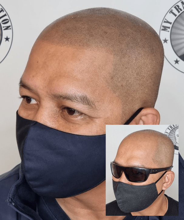 My Transformation, Scalp Micropigmentation Perth, Hair Tattoo Perth, MP Perth, SMP WA, Perth Australia