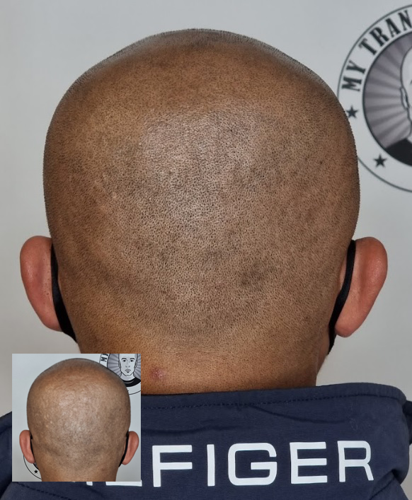 My Transformation, Scalp Micropigmentation Perth, Hair Tattoo Perth, MP Perth, SMP WA, Perth Australia