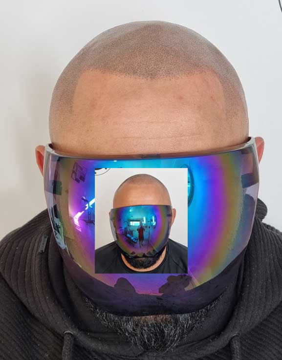 My Transformation, Scalp Micropigmentation Perth, Hair Tattoo Perth, MP Perth, SMP WA, Perth Australia