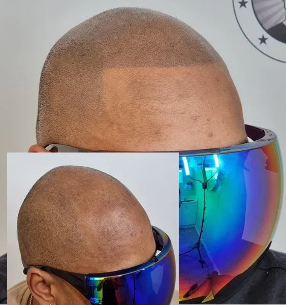 My Transformation, Scalp Micropigmentation Perth, Hair Tattoo Perth, MP Perth, SMP WA, Perth Australia