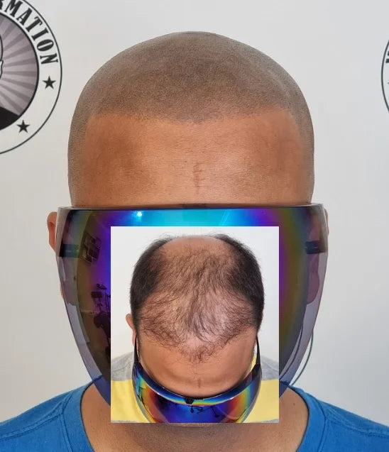 My Transformation, Scalp Micropigmentation Perth, Hair Tattoo Perth, MP Perth, SMP WA, Perth Australia