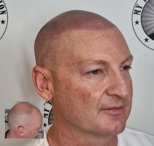 My Transformation, Scalp Micropigmentation Perth, Hair Tattoo Perth, MP Perth, SMP WA, Perth Australia