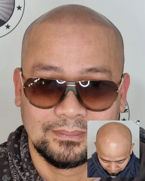 My Transformation, Scalp Micropigmentation Perth, Hair Tattoo Perth, MP Perth, SMP WA, Perth Australia