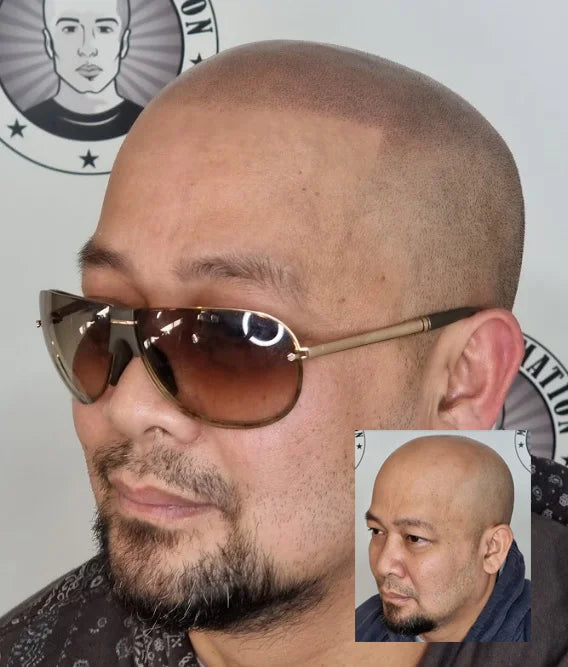 My Transformation, Scalp Micropigmentation Perth, Hair Tattoo Perth, MP Perth, SMP WA, Perth Australia