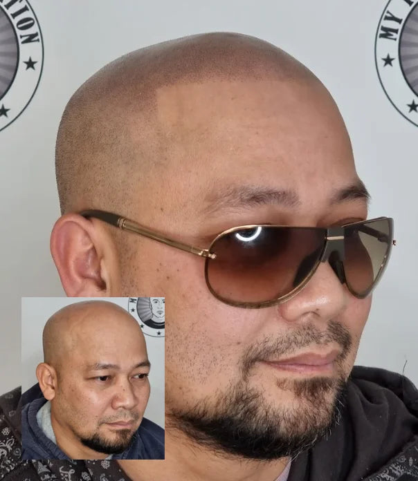 My Transformation, Scalp Micropigmentation Perth, Hair Tattoo Perth, MP Perth, SMP WA, Perth Australia