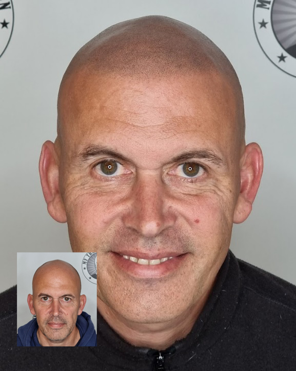 My Transformation, Scalp Micropigmentation Perth, Hair Tattoo Perth, SMP Perth, SMP WA, Perth Australia