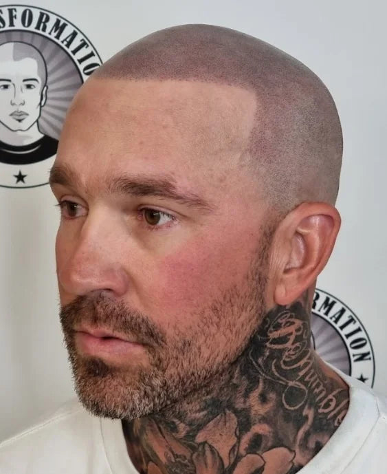 My Transformation, Scalp Micropigmentation Perth, Hair Tattoo Perth, MP Perth, SMP WA, Perth Australia