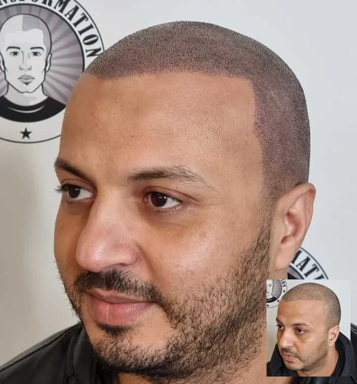 My Transformation, Scalp Micropigmentation Perth, Hair Tattoo Perth, MP Perth, SMP WA, Perth Australia