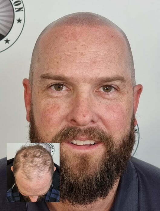 My Transformation, Scalp Micropigmentation Perth, Hair Tattoo Perth, MP Perth, SMP WA, Perth Australia