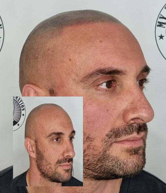 My Transformation, Scalp Micropigmentation Perth, Hair Tattoo Perth, MP Perth, SMP WA, Perth Australia