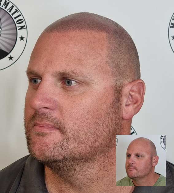 My Transformation, Scalp Micropigmentation Perth, Hair Tattoo Perth, MP Perth, SMP WA, Perth Australia