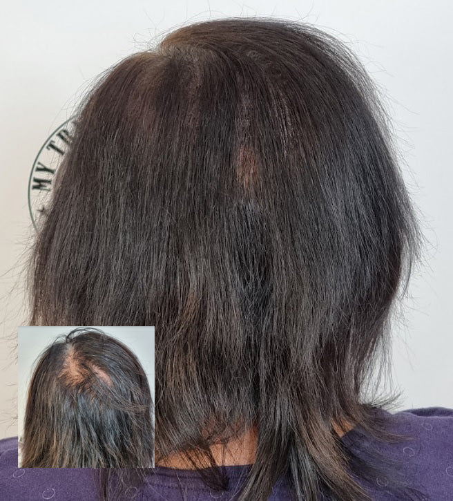 My Transformation, Scalp Micropigmentation Perth, Women's Hair Tattoo Perth, SMP Perth, SMP WA, Perth Australia