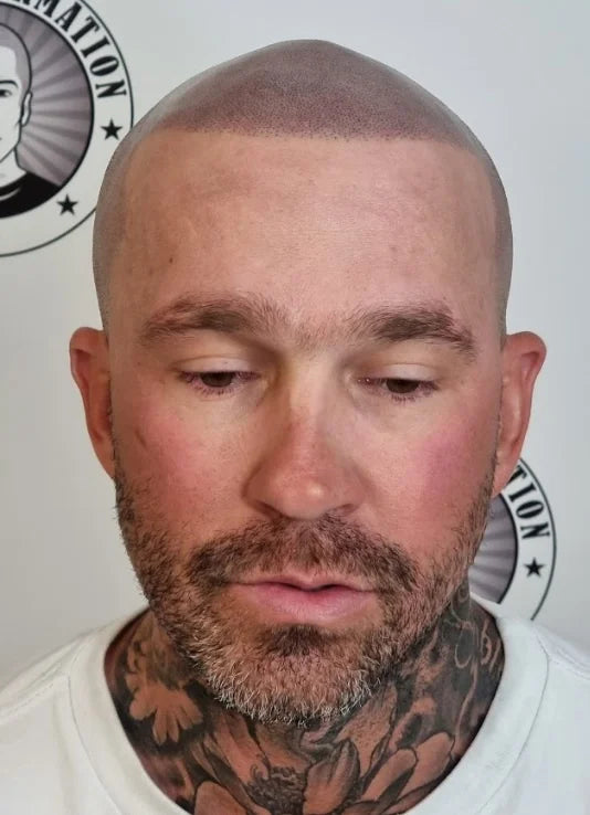 My Transformation, Scalp Micropigmentation Perth, Hair Tattoo Perth, MP Perth, SMP WA, Perth Australia